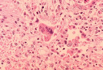 Measles Outbreaks: The Legal Challenges Of Public Good Vs. Personal Rights