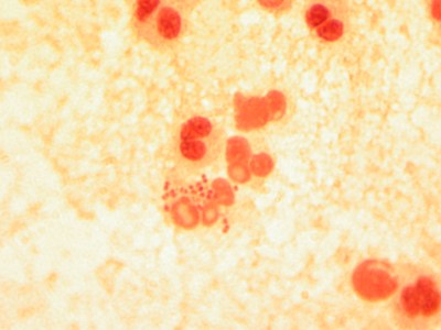 Drug-Resistant Gonorrhea Strain In Hawaii A First For U.S.