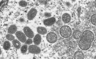 Hawaii Says All 5 Monkeypox Cases Are Linked