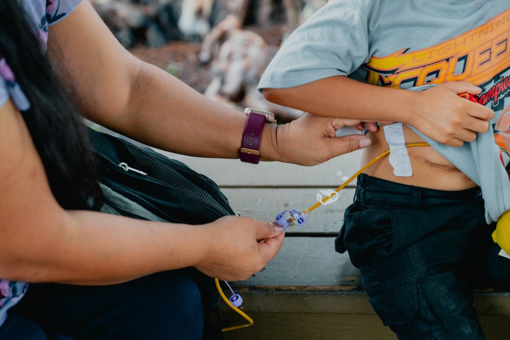 Closeup of Leilani Kaliawa fixing the tubing of her son Jeremiah's feeding tube.